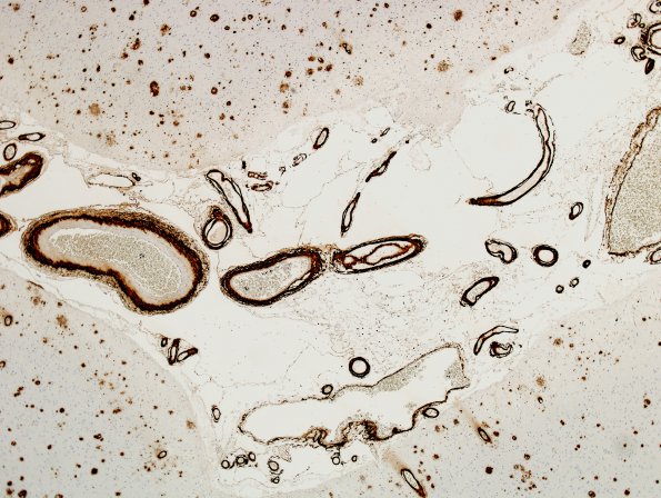 2C4 Congophilic Angiopathy (Case 2) BAmyloid