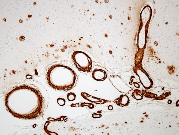 2C5 Congophilic Angiopathy (Case 2) BAmyloid 1