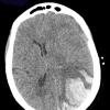 31A1 Congophilic Angiopathy (Case 31) CT 1 - Copy