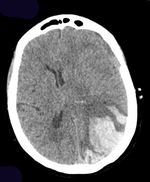 31A1 Congophilic Angiopathy (Case 31) CT 1 - Copy