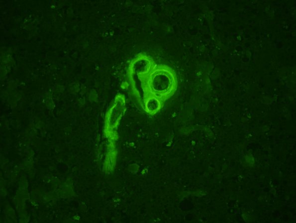 31C Congophilic Angiopathy (Case 31) 2a - Copy