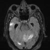 3A1 Congophilic Angiopathy (Case 3) FLAIR 1 - Copy