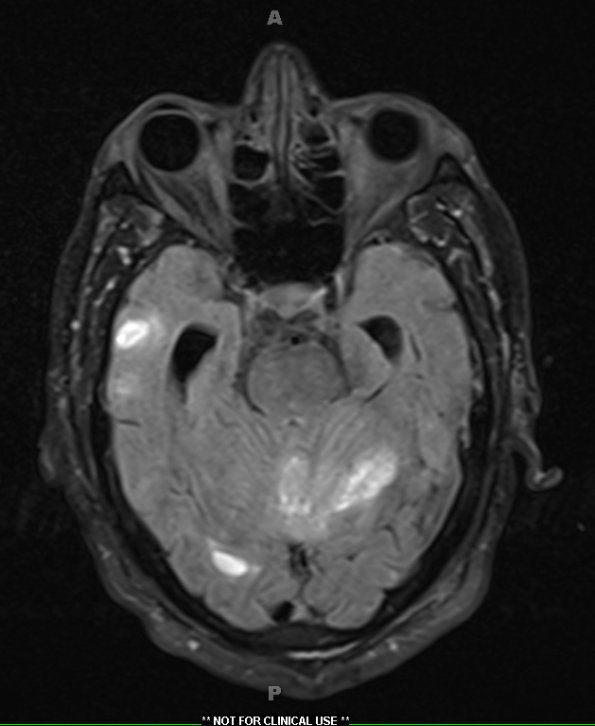 3A1 Congophilic Angiopathy (Case 3) FLAIR 1 - Copy