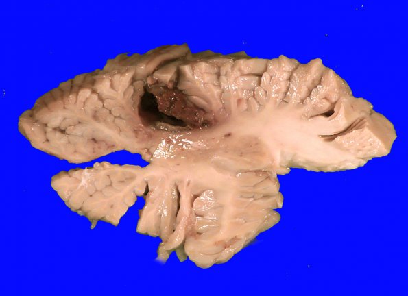 3B2 Congophilic Angiopathy (Case 3) _7