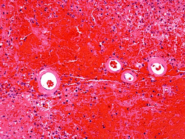 3C Congophilic Angiopathy (Case 3) H&E 5