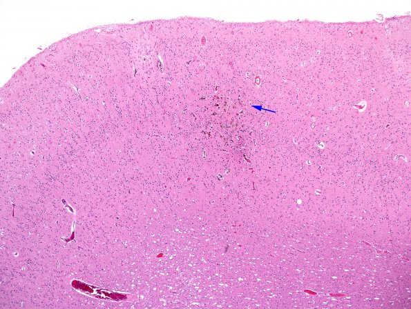 3D2 Congophilic Angiopathy (Case 3) H&E 7 copy