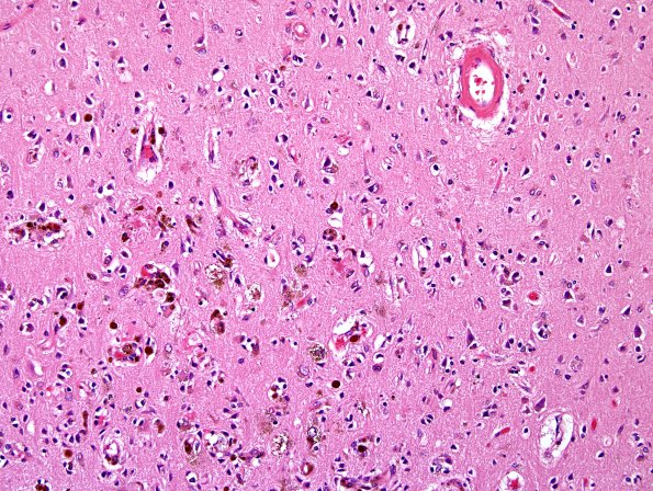 3D3 Congophilic Angiopathy (Case 3) H&E 6