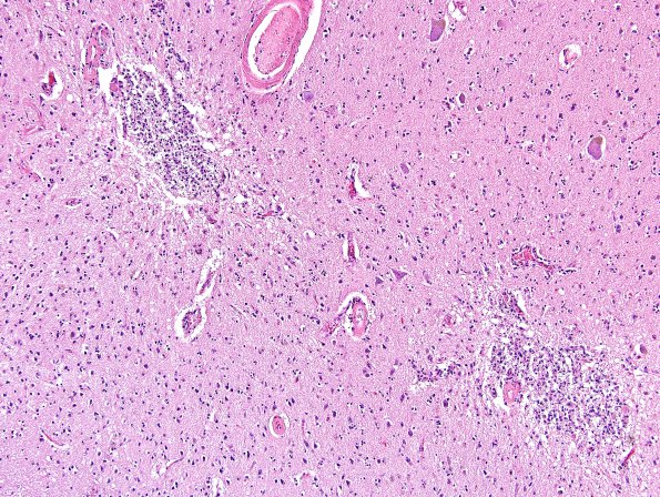 3D4 Congophilic Angiopathy (Case 3) H&E 10