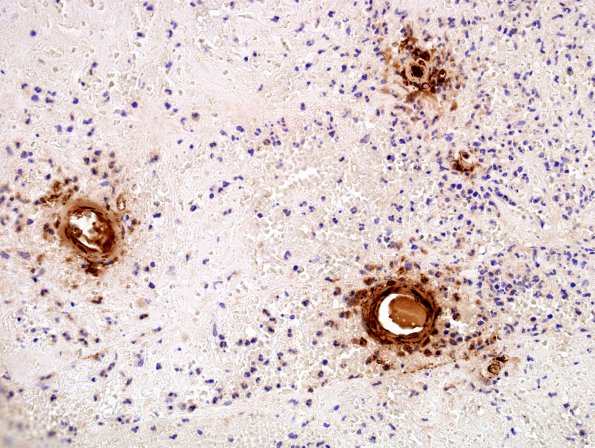 3E2 Congophilic Angiopathy (Case 3) BAmyloid 1