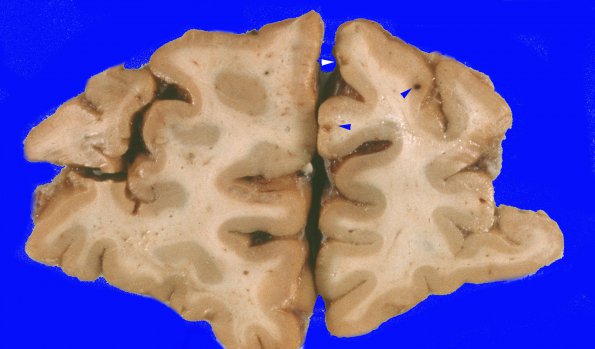 4A1 Congophilic Angiopathy (Case 4) 5 copy