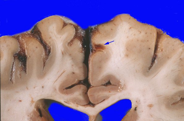 4A2 Congophilic Angiopathy (Case 4) 8 copy