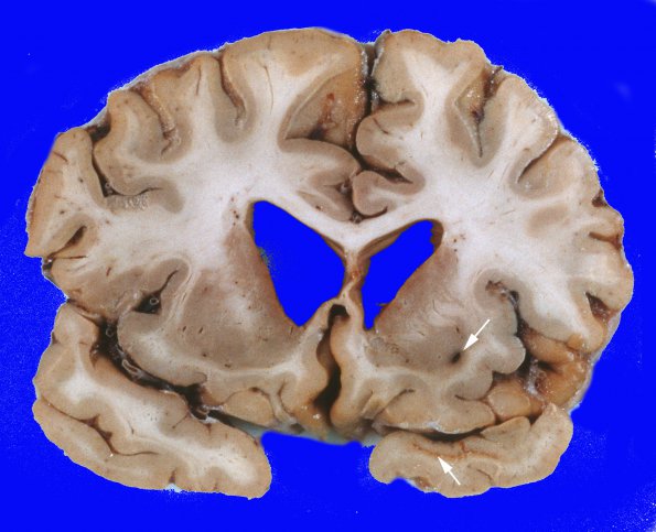 4A3 Congophilic Angiopathy & AD (Case 4) Gross 11 copy