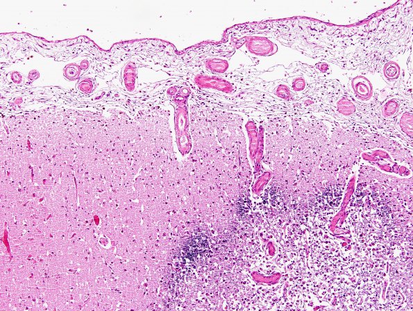 4B10 Congophilic Angiopathy (Case 4) H&E 19