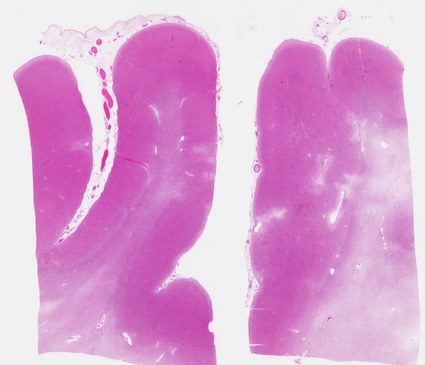 4B2 Congophilic Angiopathy (Case 4) H&E WM