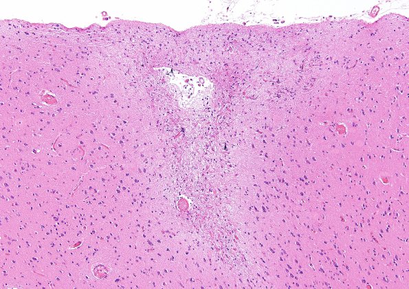 4B3 Congophilic Angiopathy (Case 4) H&E 18