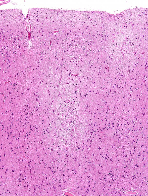 4B4 Congophilic Angiopathy (Case 4) H&E 15