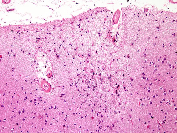 4B5 Congophilic Angiopathy (Case 4) H&E 10