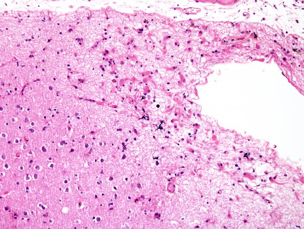 4B6 Congophilic Angiopathy (Case 4) H&E 9