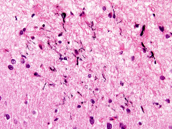 4B7 Congophilic Angiopathy (Case 4) H&E 11