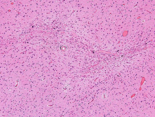 4B8 Congophilic Angiopathy (Case 4) H&E 12