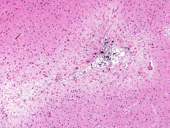 4B9 Congophilic Angiopathy (Case 4) H&E 13