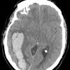 5A1 Hemorrhage, congophilic angiopathy (Case 5) ax ct 2 copy - Copy