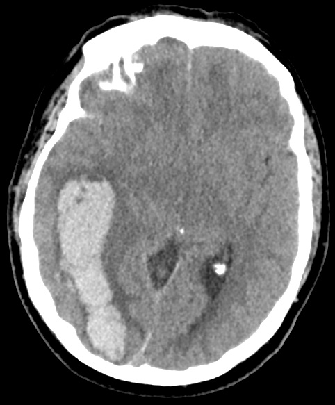 5A1 Hemorrhage, congophilic angiopathy (Case 5) ax ct 2 copy - Copy