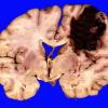 5B1 Hemorrhage, congophilic angiopathy (Case 5) _5