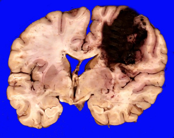 5B1 Hemorrhage, congophilic angiopathy (Case 5) _5