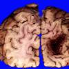 5B2 Hemorrhage, congophilic angiopathy (Case 5) _7