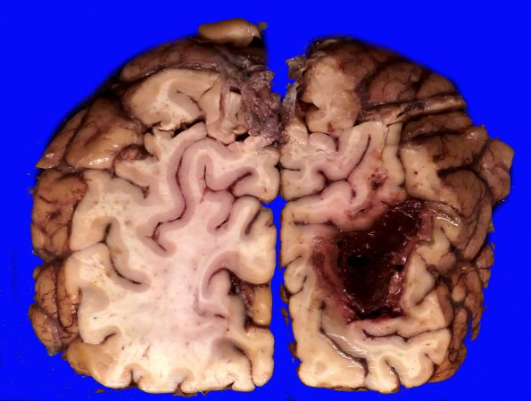 5B2 Hemorrhage, congophilic angiopathy (Case 5) _7