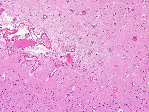 5C1 Hemorrhage, congophilic angiopathy (Case 5)  N5 H&E 10X 1