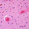 5C2 Hemorrhage, congophilic angiopathy (Case 5) N1 H&E 1