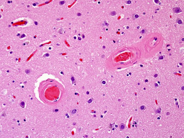 5C2 Hemorrhage, congophilic angiopathy (Case 5) N1 H&E 1