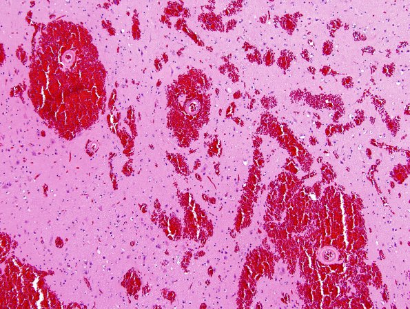 5C3 Hemorrhage, congophilic angiopathy (Case 5)  N13 H&E 10X 2