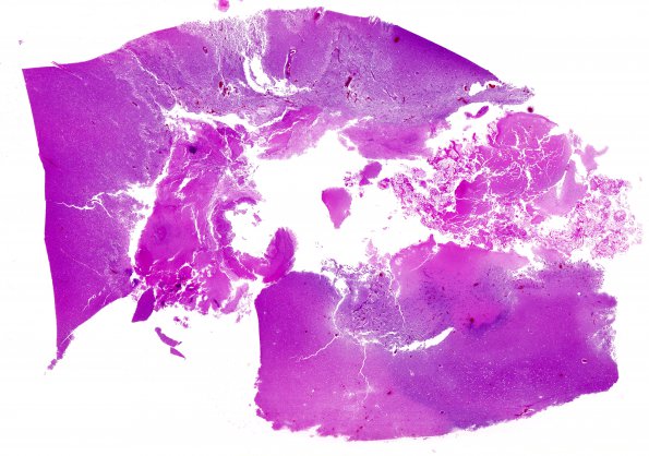 5C4 Hemorrhage, congophilic angiopathy (Case 5)  N12 H&E whole mount