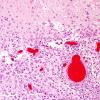 5C5 Hemorrhage, congophilic angiopathy (Case 5) N12 H&E 8