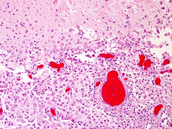 5C5 Hemorrhage, congophilic angiopathy (Case 5) N12 H&E 8