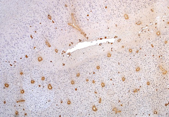 5D Congophilic angiopathy (Case 5) N5 B-amyloid 9