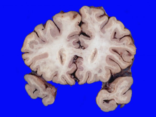 6A1 Congophilic Angiopathy (AD,PD,CAA, ABRA, Case 6) 8