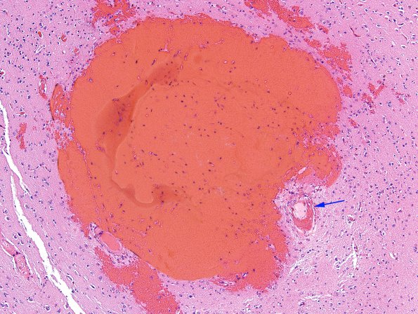 6B4 Congophilic Angiopathy (AD,PD,CAA, ABRA, Case 6) H&E 6 copy