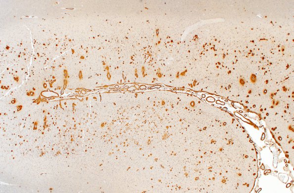 6C Congophilic Angiopathy (AD,PD,CAA, ABRA, Case 6) N1 BAP 2X