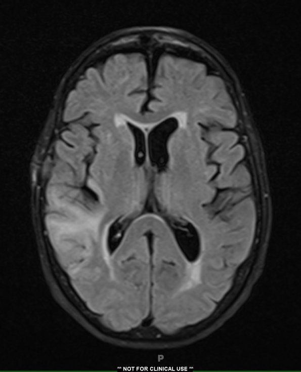 7A1 CAA (Case 7) FLAIR - Copy