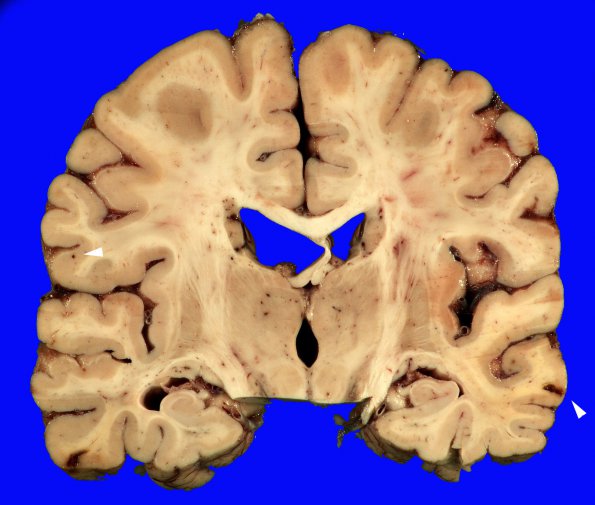 7B Congophilic Angiopathy (Case 7) 7 copy