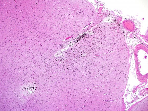 7C2 Congophilic Angiopathy (Case 7) N15 H&E Cellsens 3