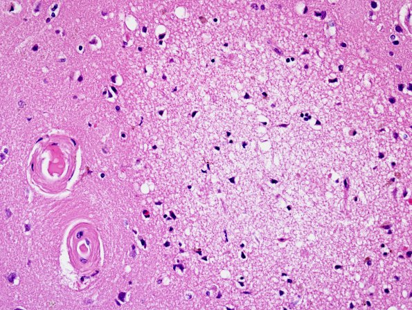 7C3 Congophilic angiopathy, multiple small infarcts (Case 7) H&E 6