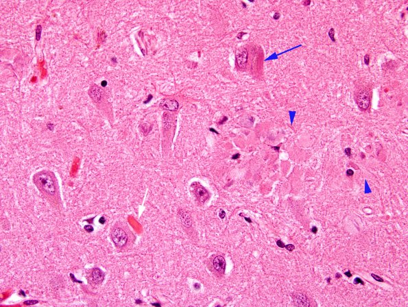 7C4 Congophilic Angiopathy (Case 7) N3 H&E 1 copy