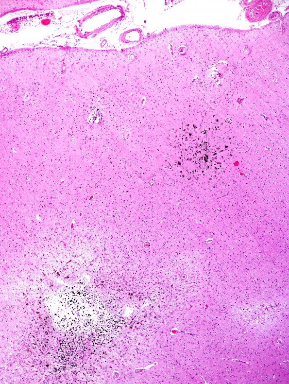 7C5 Congophilic Angiopathy (Case 7) N14 H&E Cellsens 1