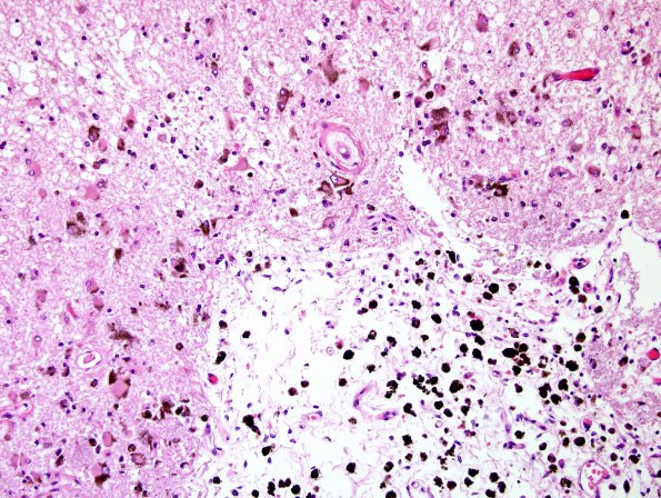 7C6 Congophilic Angiopathy (Case 7) N14 H&E 3A