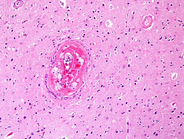 7C7 Congophilic Angiopathy (Case 7) N15 H&E 5